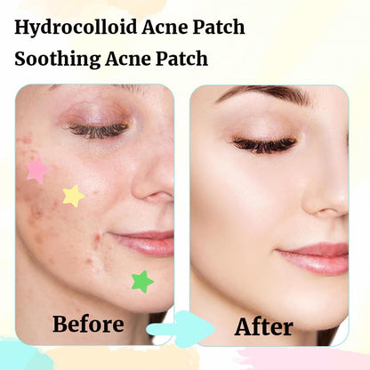 357 PCS Pimple Patches, Parches Acne Pimple Patches Aceite De Árbol De Té Y Ácido Salicílico Parches Granos Acne Invisibles Y De Absorción Impermeable Pueden Deshacerse Acné Rápidamente